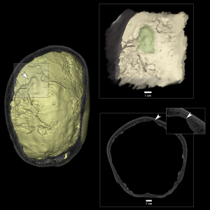 MicroCT y tumor